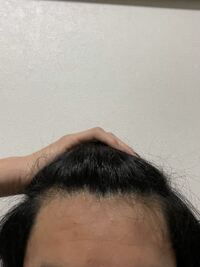 最近ダーマローラー 外用薬での発毛 育毛に関する動画を見たのですが Yahoo 知恵袋