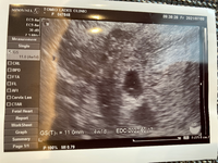 5週６日で11ミリの胎嚢とその中に赤ちゃんの素を確認出来ました G Yahoo 知恵袋
