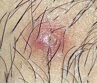陰部にニキビができてしまいました 膿がパンパンになっていてふ Yahoo 知恵袋