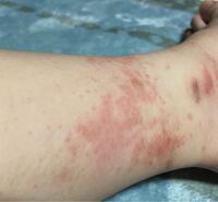 ハイドロキノン使用2日目でこのように温疹が出ました これは副作用でしょ Yahoo 知恵袋