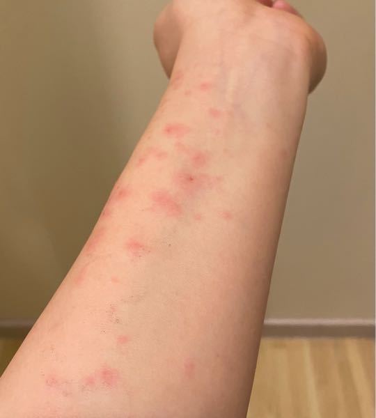 これは漆によるかぶれなんでしょうか 漆でかぶれた場合は大抵1 Yahoo 知恵袋