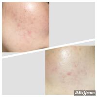 中3です いま ニキビとニキビ跡に悩んでいます ニキビは お菓子や食生 Yahoo 知恵袋