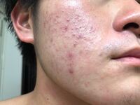 この肌荒れを治す方法はありますか ニキビ跡なので諦めたほうが良いのでしょうか Yahoo 知恵袋