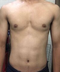 女性化乳房についての質問です この写真は女性化乳房になっているのでしょ Yahoo 知恵袋