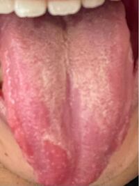 舌の画像ですけれども これは舌苔ですか それとも 白板症もしくはそ Yahoo 知恵袋