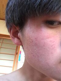 こんばんは の男です 肌についての質問です 最近頬からもみあげの辺りまで Yahoo 知恵袋