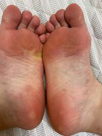 足の裏が痛くて痒くて歩くのも辛いです 水虫ではなさそうで 履き慣れてる Yahoo 知恵袋