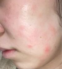 写真有り ここ数ヶ月肌荒れが酷く 治らないです これは化粧水を塗 Yahoo 知恵袋