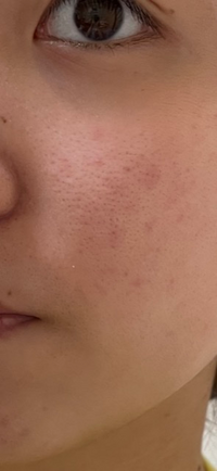 たすけてください 頬と鼻の毛穴が目立って仕方ないです 黒ずみや角栓 Yahoo 知恵袋