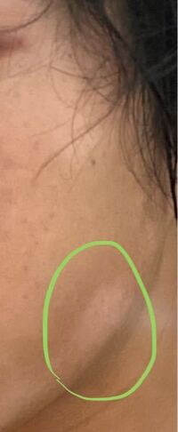 顔のこの部分だけなんか白くなってるのですがこれは白斑と言う症状でし Yahoo 知恵袋