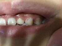 子供の歯について 歯と 歯茎の間に ピンクの薄い膜のようなものが現れる時があ Yahoo 知恵袋