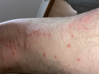 閲覧注意です 虫刺されでしょうか ムヒなどを塗っていますが一向に良 Yahoo 知恵袋