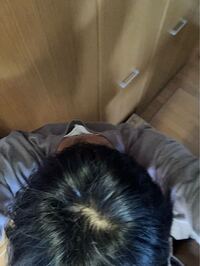 高3です これはハゲてきていますか Yahoo 知恵袋