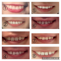 歯科矯正失敗 以前も知恵袋でご相談させていただいたのですが やはり Yahoo 知恵袋