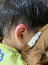 プールから帰ってきて耳を見たらすごい腫れてました 蕁麻疹でしょうか ま Yahoo 知恵袋