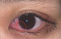 目が充血して 目の中にずっと何かがあるような状態で 目薬と眼帯で赤みが収 Yahoo 知恵袋