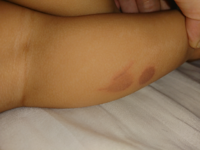 1歳の息子の足の出来物について 先週日曜日に主人と外出の用があり 義実 Yahoo 知恵袋