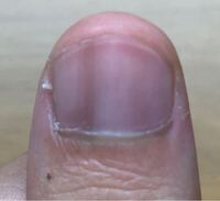コラム 2 抗がん剤によって爪におきる症状 変色 筋が入る 目黒区自由が丘 がん治療中でもいつもの髪形で笑顔の生活 自然に見えるウィッグを作る 爪 眉毛の相談も 高溝のブログ