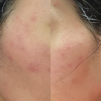 初めて美容皮膚科でダーマペン4を受けてきました 27歳女です ダー Yahoo 知恵袋