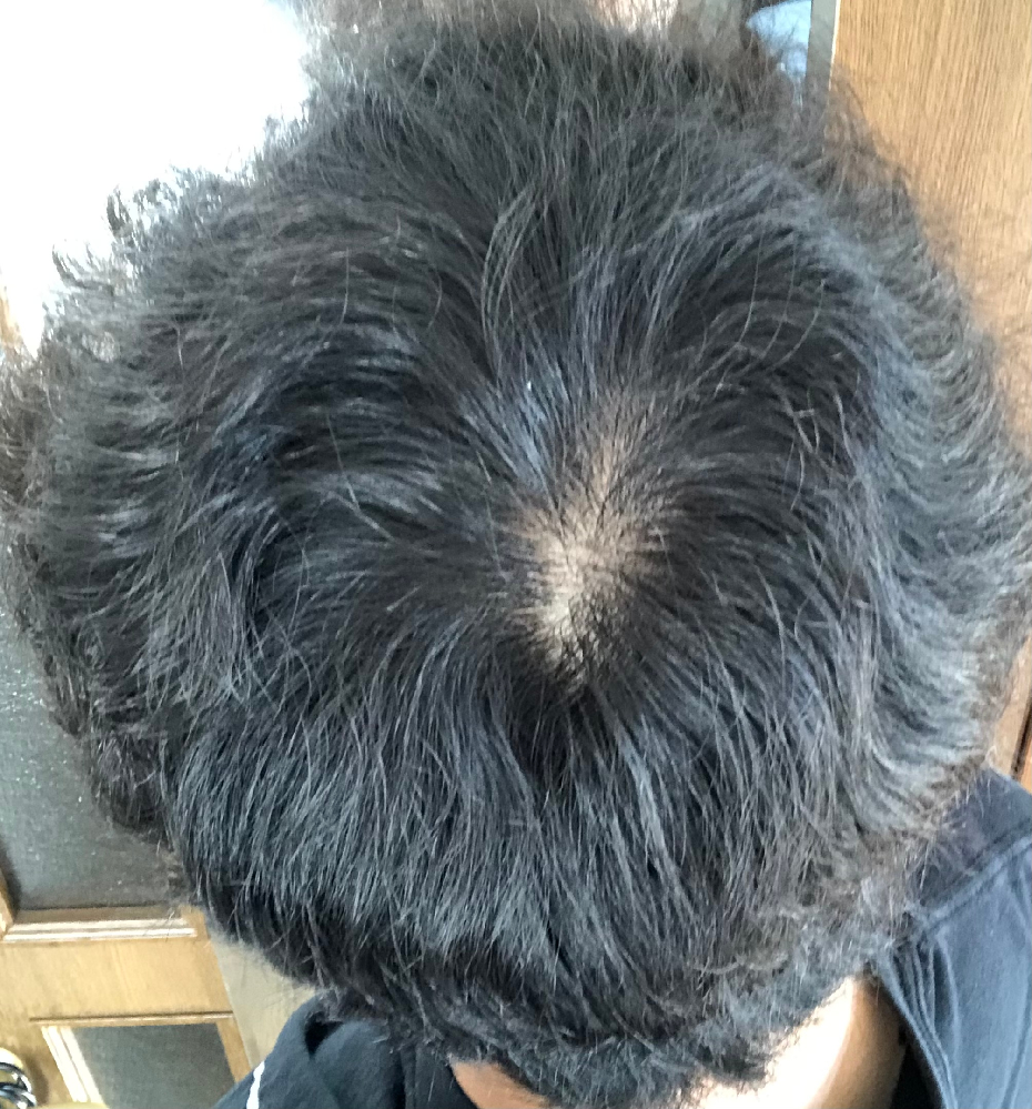 寝起きのつむじなのですが、薄いですか？髪質は猫っ毛で天然パーマです 