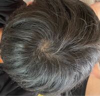 白髪が多いです 栄養不足ということなんですかね このままだと禿げそうで怖いで Yahoo 知恵袋