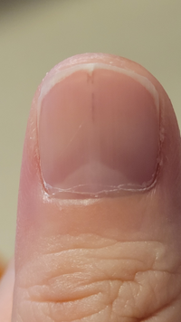 爪の黒い線が半年程あります 最初は爪の真ん中が縦に割れる症状で 治ってまた Yahoo 知恵袋