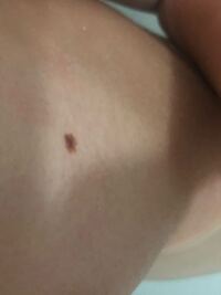 胸の横にこのような大きめの黒子 があります 毎日見ているのですが 心なしが段 Yahoo 知恵袋