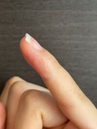 写真のように 指に透明なぶつぶつができます ぼろっと鱗のように剥がれて Yahoo 知恵袋