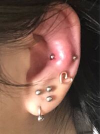 スナッグ開けて3日目です この腫れは普通ですか ピアスを付 Yahoo 知恵袋