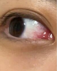 目がかゆいです 写真あります 目頭と白い角膜 のところの境目が水膨れ Yahoo 知恵袋