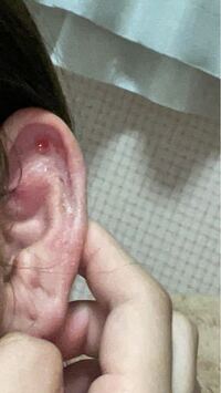 ピアスホールの周りがカサカサ します ピアスを開けて半年くらいにな Yahoo 知恵袋