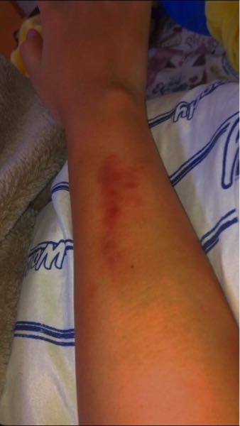 閲覧注意腕のあざを隠す方法はありますか 学校へ行くとき腕のあざを Yahoo 知恵袋