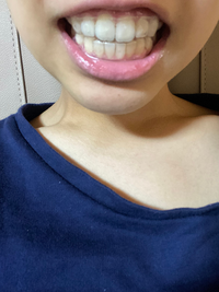 女子高1年生です 先日歯列矯正が終わりリテーナーをしていますが こ Yahoo 知恵袋