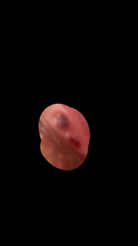 閲覧注意です 陰部に血豆のようなできものがあります これは治ります Yahoo 知恵袋