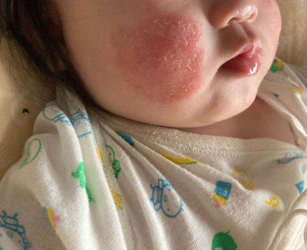 生後7ヶ月の女の子このように頬がただれていて 昨日予防接種だったの Yahoo 知恵袋