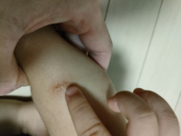 子供の虫刺されについて 虫刺されあとが変なんですが これ何に Yahoo 知恵袋