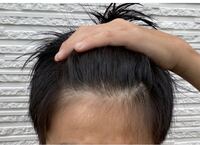 これはいわゆるハゲですか Yahoo 知恵袋