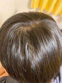 高1男子です元々髪の毛自体が細く柔らかい毛で毛量もなかったんですが最近つむじ Yahoo 知恵袋