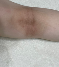 膝裏の黒ずみについてここ半年ずっと膝裏 肘裏が痒く 掻き毟ってしま Yahoo 知恵袋