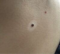 お腹のところにほくろがあるんですけど何故かそのほくろの周りが白いんです Yahoo 知恵袋