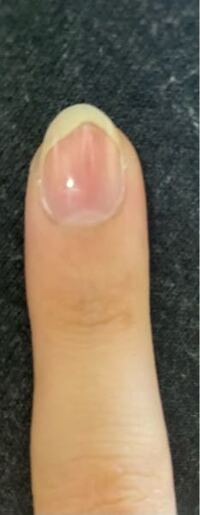 爪の白い部分とピンクの部分の形が変です どうすればきれいになりますか Yahoo 知恵袋