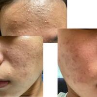 中学生中2ニキビ ニキビがやばいです ニキビの治し方とニキビ跡の治し方を Yahoo 知恵袋