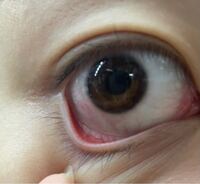 コンタクトを外したあと充血してるように感じます ですが全然痛くもなくゴロ Yahoo 知恵袋