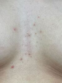 汚い画像失礼します 1年くらい前から谷間のニキビが酷く治りません これ Yahoo 知恵袋