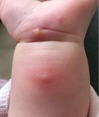 生後3ヶ月の赤ちゃんの手首に湿疹ができました 蚊なら良いのですが 腫れ Yahoo 知恵袋