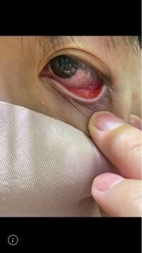 目が充血しています 擦ったのが原因だとは思うのですが これはなんでしょ Yahoo 知恵袋