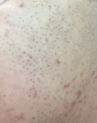 皮膚科へ相談してもよいでしょうか 30代男です 大人になってから肌の状 Yahoo 知恵袋