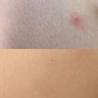 ここ1ヶ月ほど虫刺されのようなしこりができます 特に痒くも痛 Yahoo 知恵袋