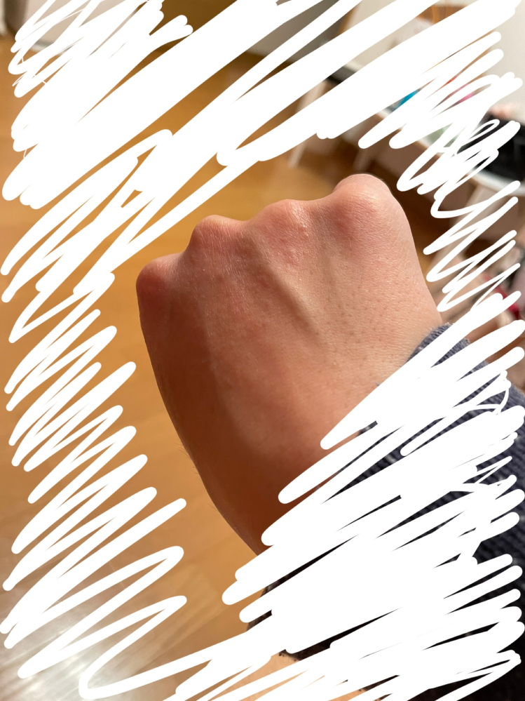 昨日の朝からこのような湿疹のようなものがでています 痒みもあり 少しピリピリ Yahoo 知恵袋