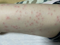 蕁麻疹 湿疹 ３日目で 赤みはあるけど腫れは引いてきました 何でしょうか Yahoo 知恵袋